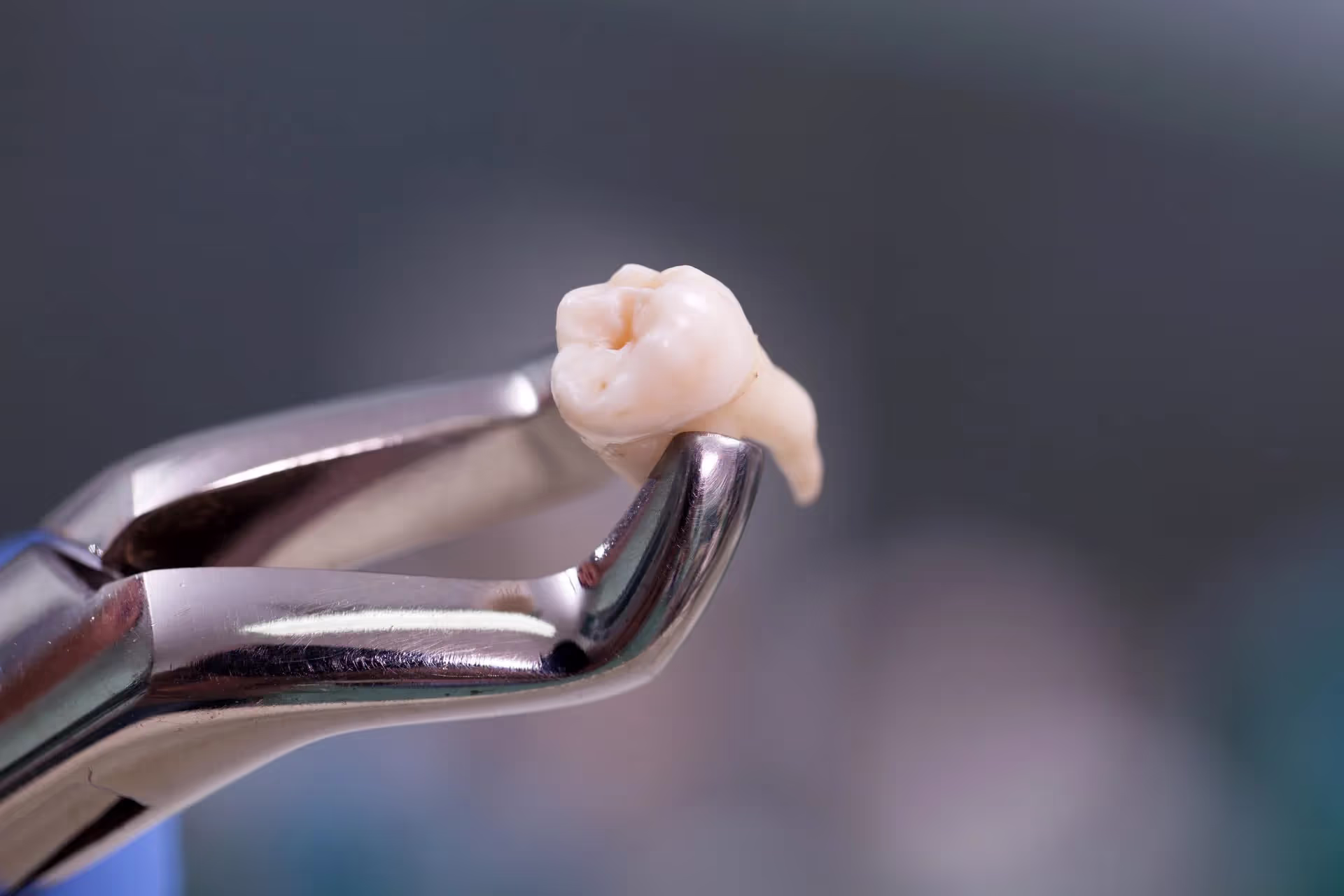 Professional Tooth Extractions in Mesquite, TX