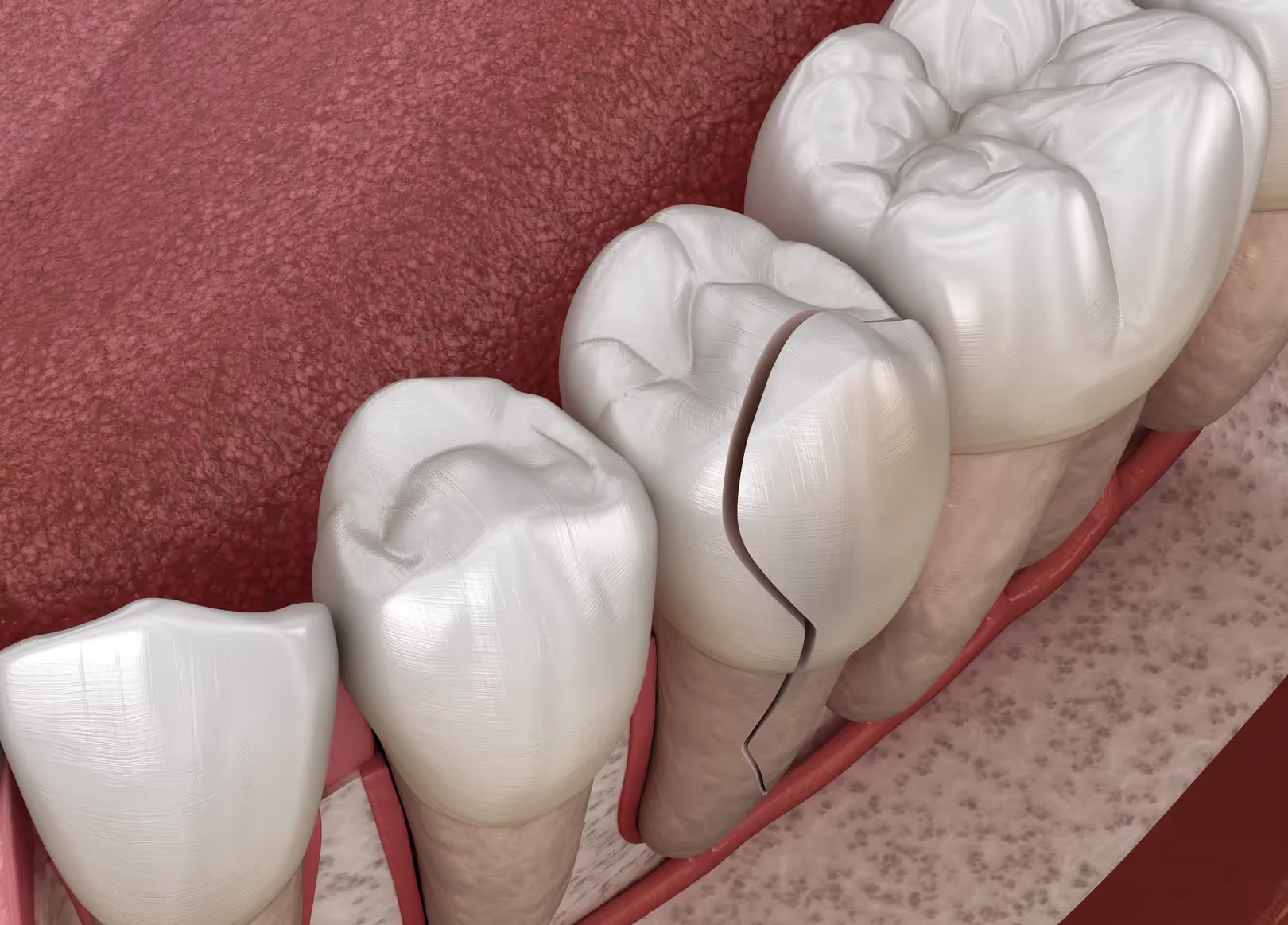 Professional Chipped Tooth Repair in Mesquite by Dr. Taylor DDS