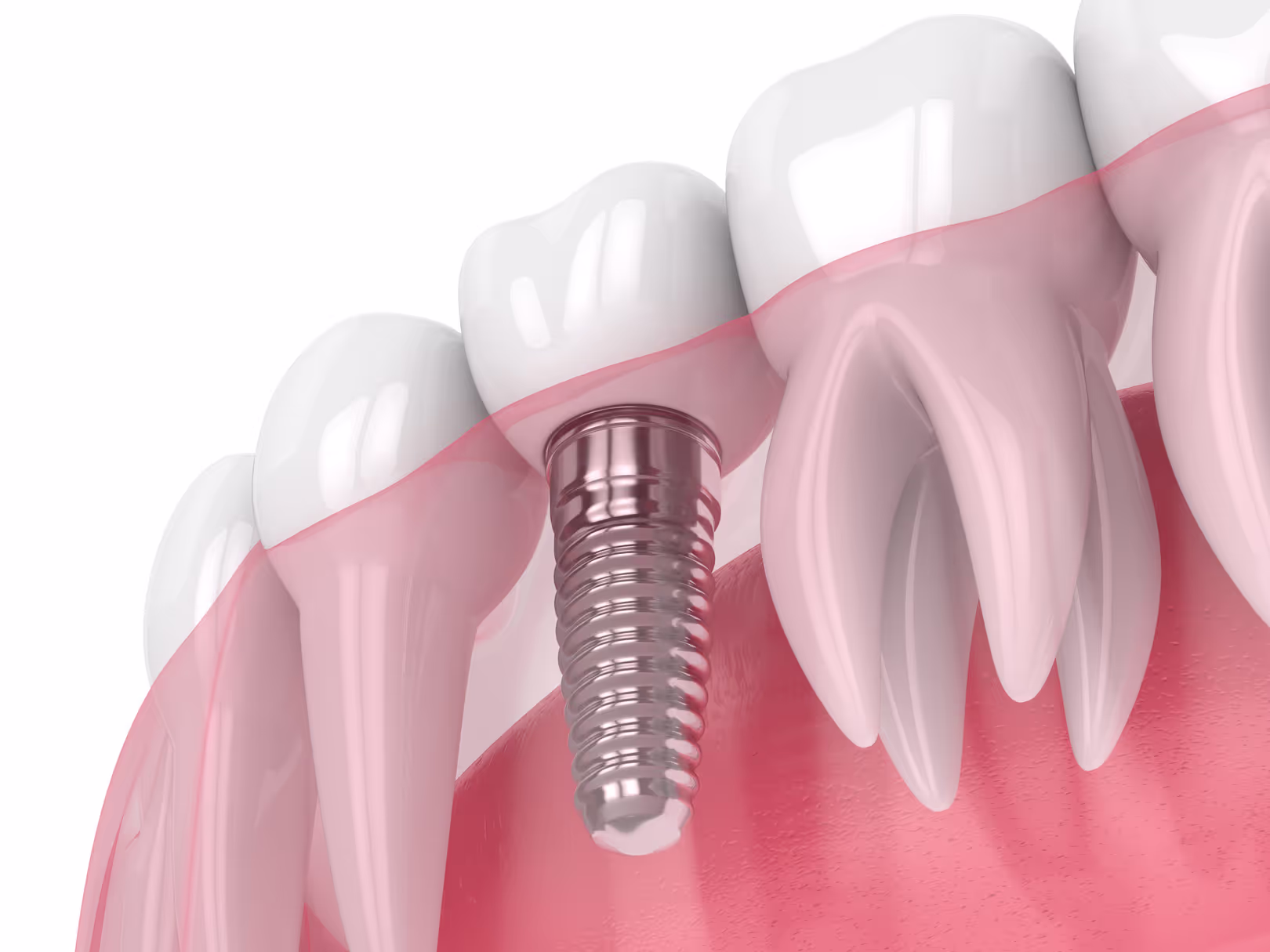 Dental Implant Restoration