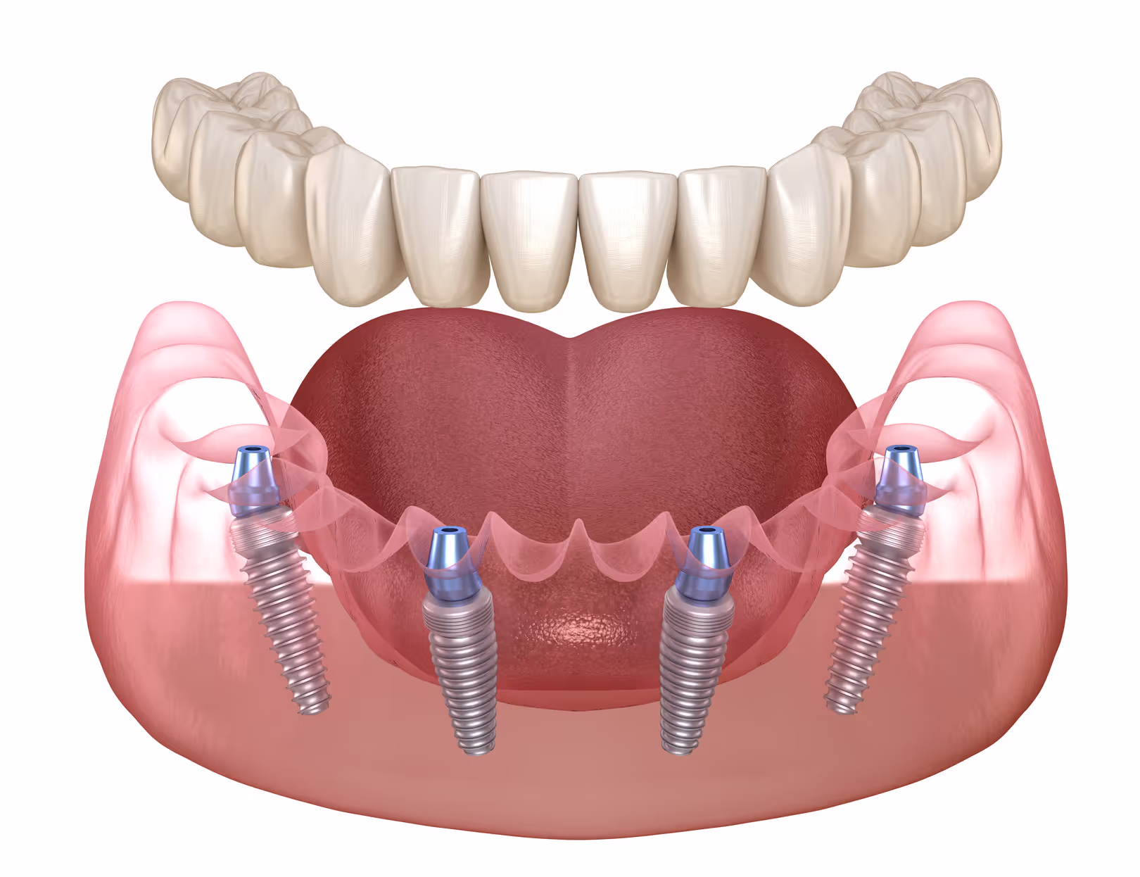 Advanced All-on-Fours Dental Implants in Mesquite, TX