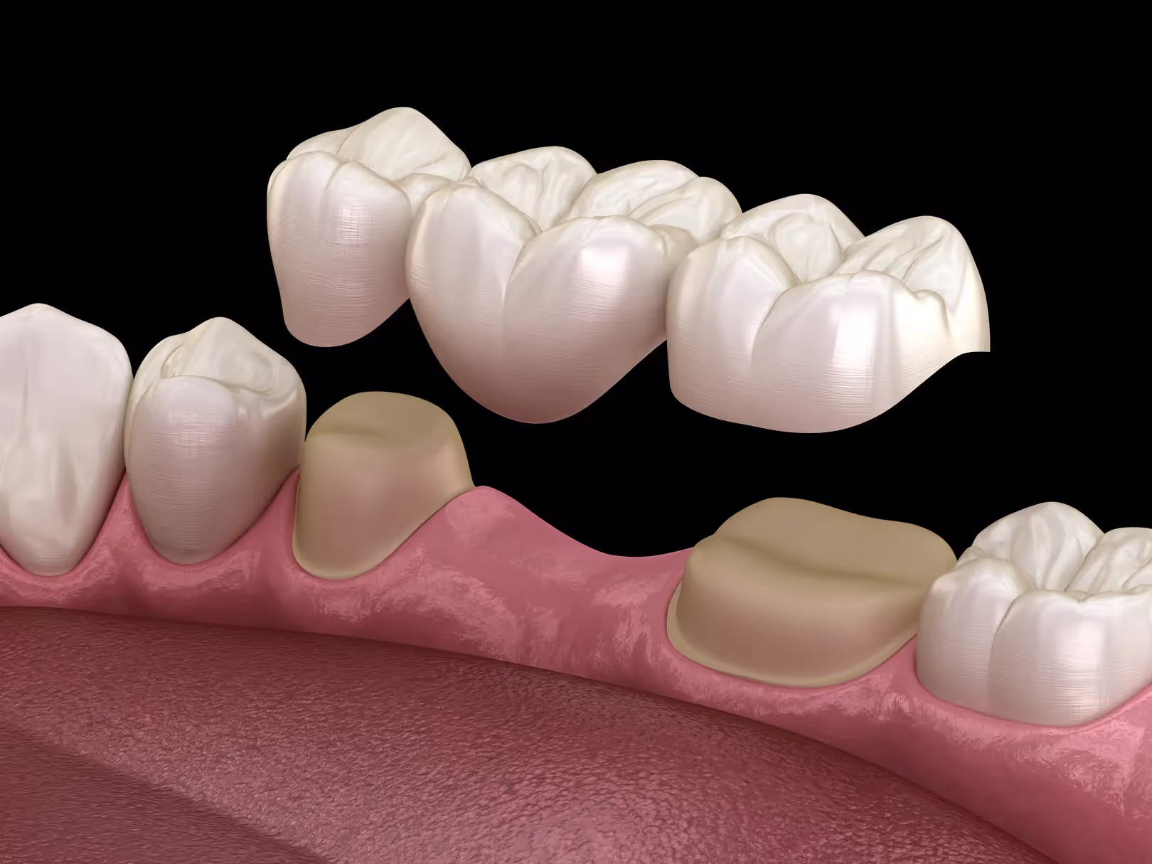 Reliable Dental Bridges in Mesquite, TX
